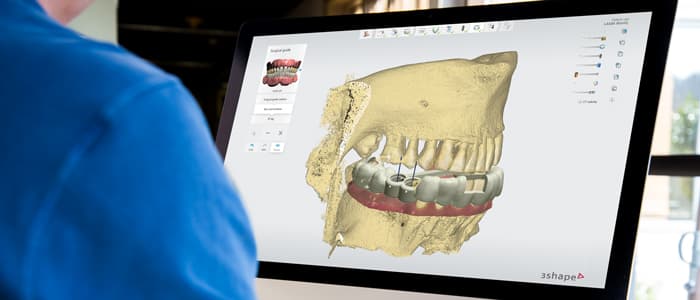 Logiciel de planification numérique du traitement implantaire montrant un guide chirurgical 3D